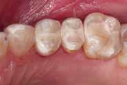 interproimal radiolucencies not present 12 months previous Required 16 restorations Need caries