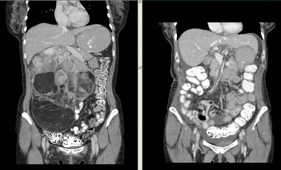Retroperitoneal STS - Rationale for pre-op RT Pre-operative Post-operative Tolerance: Acute: bowel displaced Late: bowel not fixed as well as not displaced Potential efficacy issues: Peritoneal