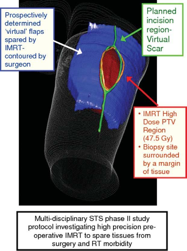 Current RT techniques (3DCRT or IMRT based) 2 phase II studies investigating 3DCRT/IMRT to spare normal tissue PMH (IMRT only) 59 pts lower extremity pts only WCs 30.5% 5-yr local RFS 88.