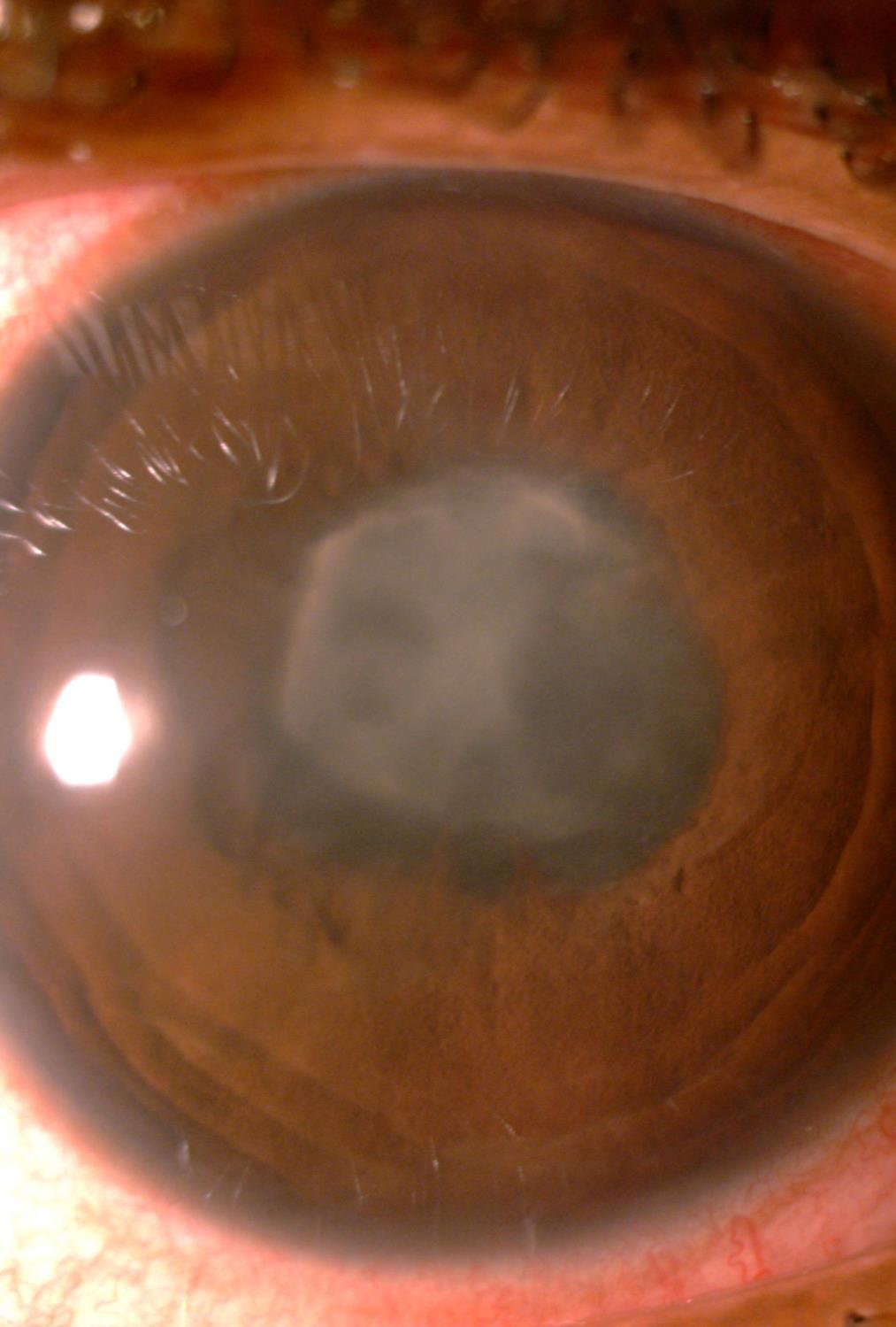Case scenario A 34 years lady Known patient of HLA B27 uveitis Third attack in