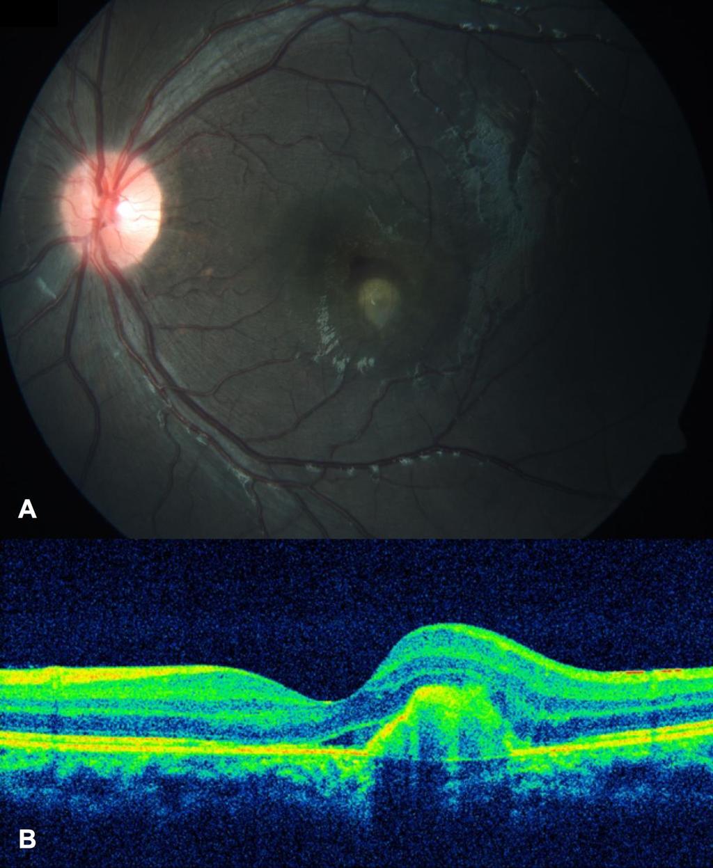 Case Scenario A 6-year-old emmetropic boy Known patient of JIA OS: Redness, ocular pain with mild diminution of vision (6/7.