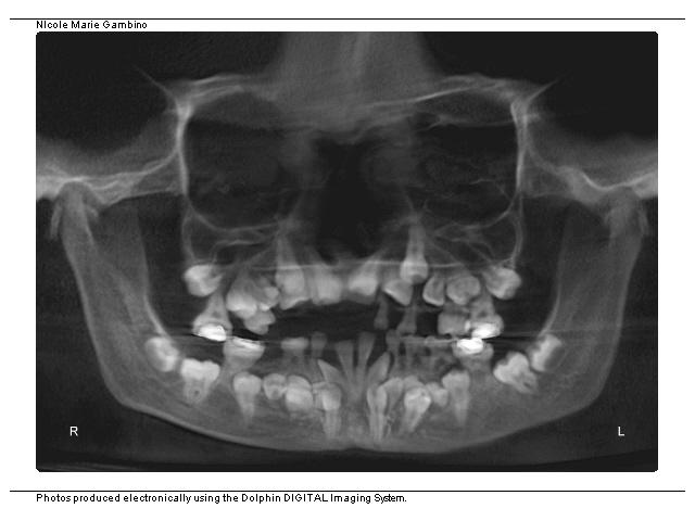 CONTRIBUTIONS OF CLEIDOCRANIAL DYSPLASIA (CCD) SPECTRUM DISORDER ON THE TEETH AND FACE Altered dentition and enamel hypoplasia Spacing in