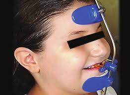 PRE-PHASE 1: AGE 7-9 Growth Modification Maxillary