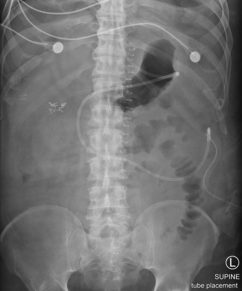 Clinical Course Delayed gastric empting Post-pyloric feeding tube successfully placed Some diarrhea, noninfectious Adjustments to EN