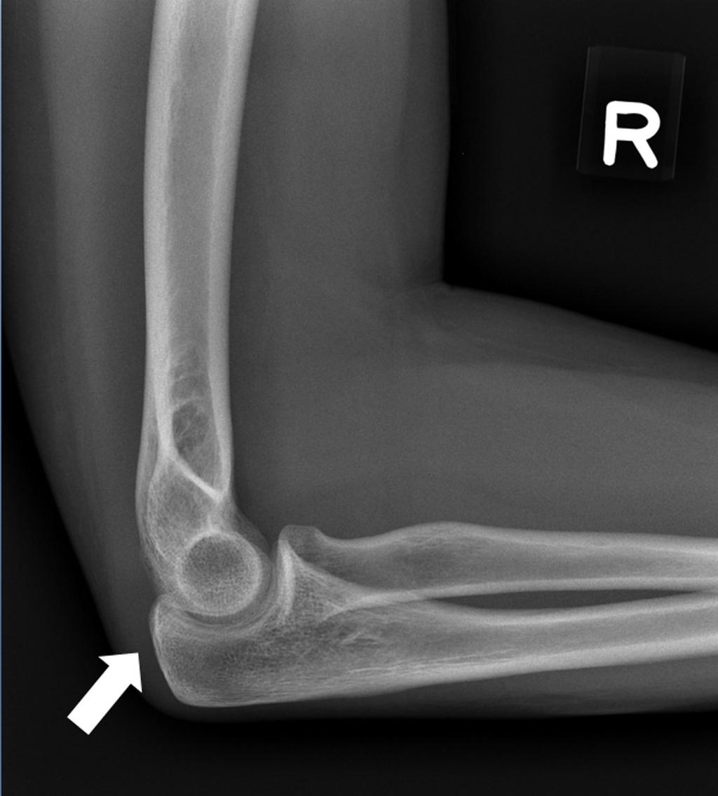 Fig. 0: 24-year old woman with calcific tendinopathy of the right triceps tendon. Radiograph before the intervention shows a thin calcification at the insertion of the triceps tendon (arrow).