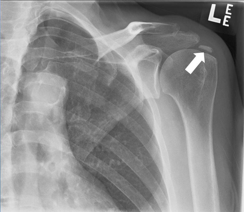 Images for this section: Fig. 0: 54-year old woman showing a calcific deposit at the level of the left supraspinatus tendon.