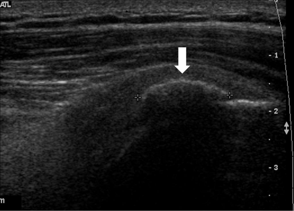 Fig. 0: 54-year old woman showing a calcific deposit at the level of the left supraspinatus tendon.