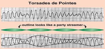 VT(no pulse) broad complex rhythm rapid rate