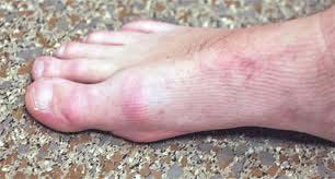 To differentiate Hallux Limitus from Turf Toe, it is essential to have an