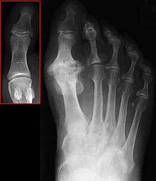 Hallux Limitus will begin as a functional condition in Stage I, and will