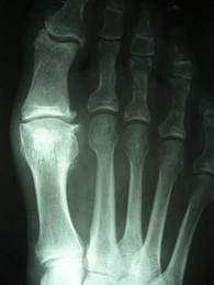Hallux Limitus is a gradual degenerative pathological condition involving the 1 st MTPJ. It can potentially progress to a full ankylosis of the joint.