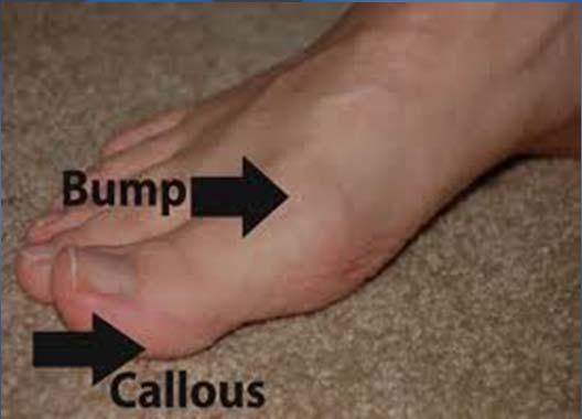 Hallux Limitus often causes callus formation on the plantar aspect of the 2 nd metatarsal head due to lack of ability