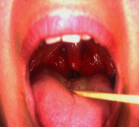 Causes of upper airway narrowing Large tonsils Tissue growth, changes in fat deposition