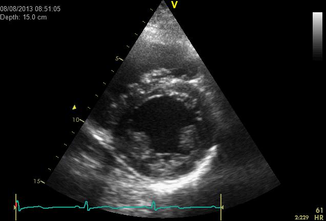 Background Acute cardiac changes in women with pre-eclampsia: preserved ejection fraction increased cardiac output pericardial effusions reduced diastolic function increased left ventricular wall