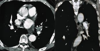 those in the posterior wall and lower part of the inferior pulmonary vein (Figs. 11, 12).
