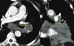 xial () and coronal () CT scans show right hilar node (colored in yellow), lying anterior to right upper lobar bronchus, posterior to anterior segmental branch of truncus anterior.