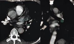 CT Diagnostic Criteria of Mediastinal and Hilar Lymphadenopathy t CT, the most reliable and practical measurement of lymph node size is the short-axis diameter, which correlates better than the