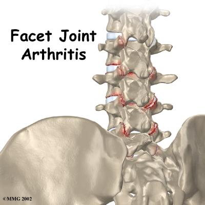 Facet joint syndrome LBP with or without somatic referral to the legs terminating