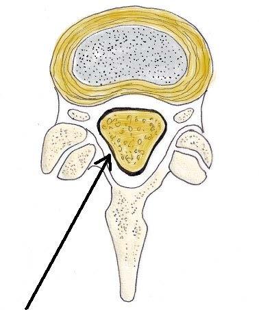 Lumbar spinal stenosis Spinal canal diameter < 10mm Progressive narrowing of