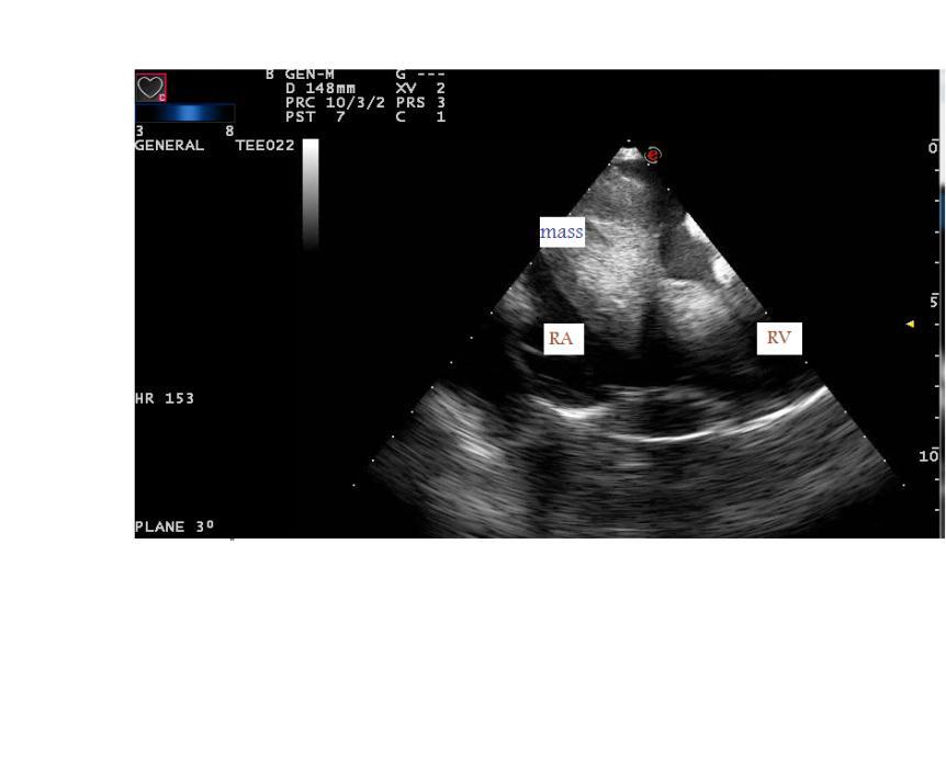 Figure 1a: Two-dimensional transesophageal echocardiography in plane about 0 shows a huge