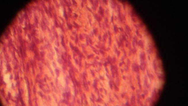 shows a solid and creamy mass with small foci of hemorrhage Figure Figure3: Microscopic