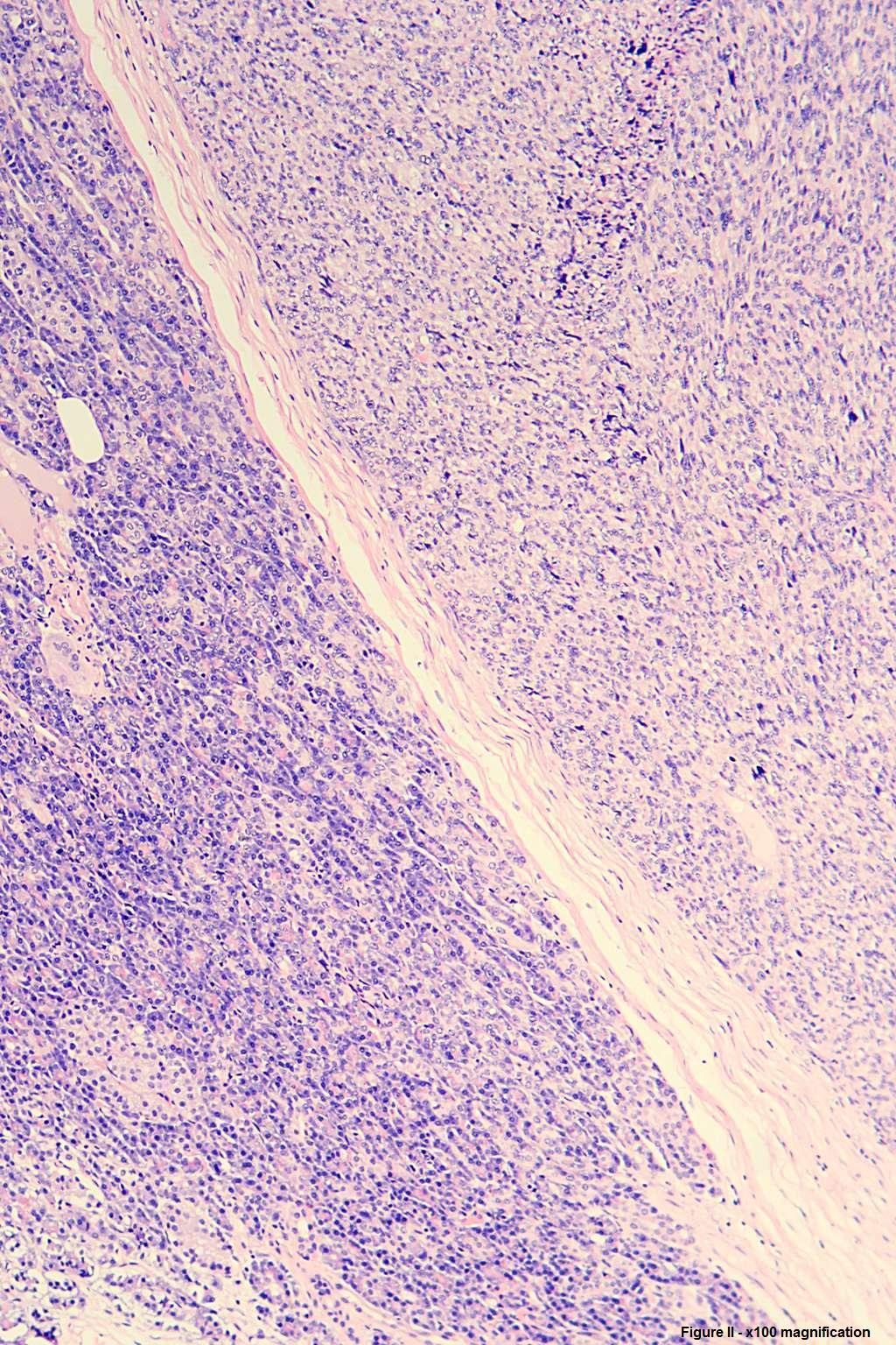 godre Case Report Figure 2: (H&E x100 magnification) A thin fibrous capsule separates the leiomyosarcoma in the top right half of the image from the normal pancreatic tissue in the bottom left