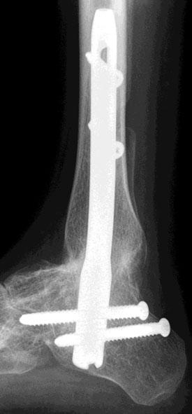 5). The only available treatment for this severe instability is an ankle fusion, which becomes a pantalar fusion due to the earlier triple arthrodesis (Fig. C1.6).