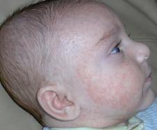 Test your knowledge with multiple-choice cases This month 8 cases: 1. Rash on Baby s Face p.26 2.Skin-coloured Papule on Shoulder p.27 3.Dermatitic Eruption Around Lips p.28 4.Itchy Back Eruption p.