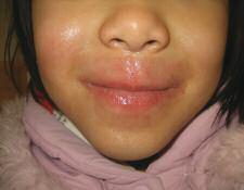 Case 3 Dermatitic Eruption Around Lips A six-year-old girl presents with a six month history of a well demarcated dermatitis eruption around the lips. a. Heck's disease b. Atopic dermatitis c.