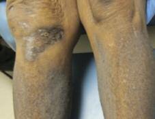Case 5 Scaly, Brown, Itchy Skin on Knees A 60-year-old female from Haiti presents with scaly brown bumps on her knees and shins that first appeared decades ago.