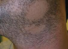 Case 6 Areas of Hair Loss on the Face A 37-year-old male is concerned with two round areas of hair loss in his beard area.