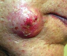 Case 7 Growing Face Lump A 46-year-old male presents with a painful lump over the right side of his face. It had been growing quickly over the last two days. a. Keratoacanthoma b. Ecthyma c.