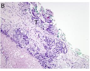 Tumor in seg 4 (resected by