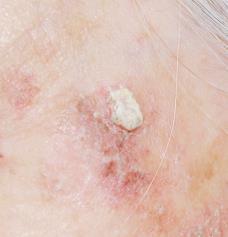Background Actinic keratosis Cutaneous neoplasm consisting of proliferations of abnormal epidermal keratinocytes that develop in response