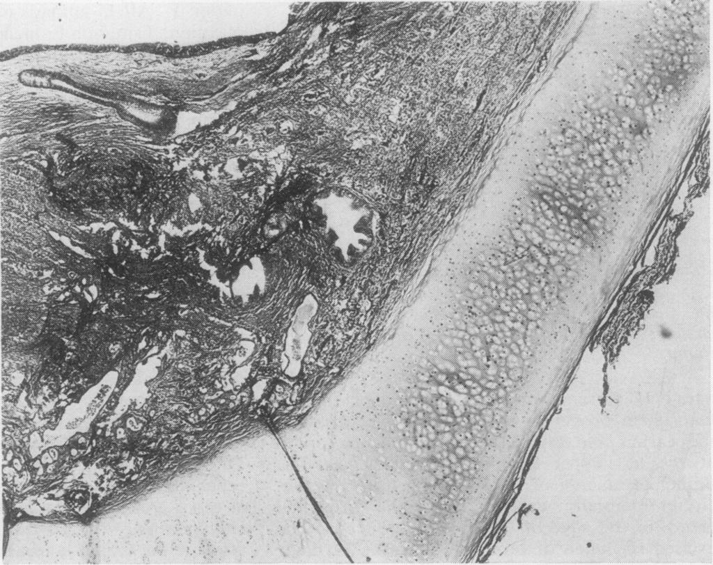 1136/thx.30.2.152 on 1 April 1975. Downloaded from http://thorax.bmj.com/ wi;bronchial FIG. 4. Dog bronchus examined at necropsy from a group I animal.