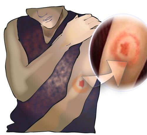 D i a g n o s i s Diagnosis is easiest when there has been a known tick bite, followed by the characteristic erythema migrans.