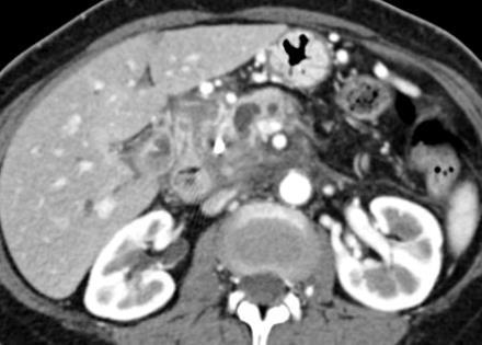 obstructing pancreatic duct Staging CT must be performed before ERCP/ EUS 1.
