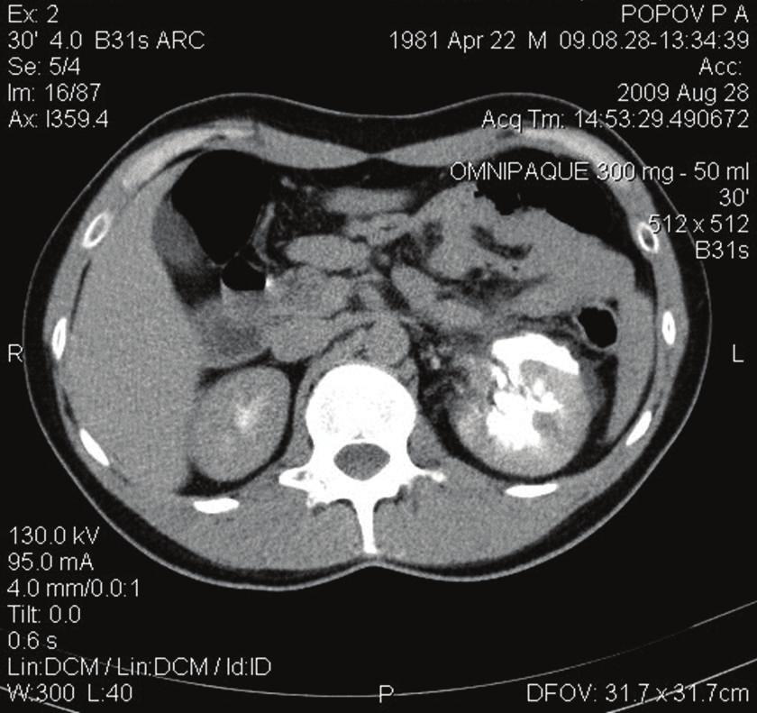 2 Figure 1: Computed tomography showing extravasation of the contrast medium through the gap in pelvis spontaneous
