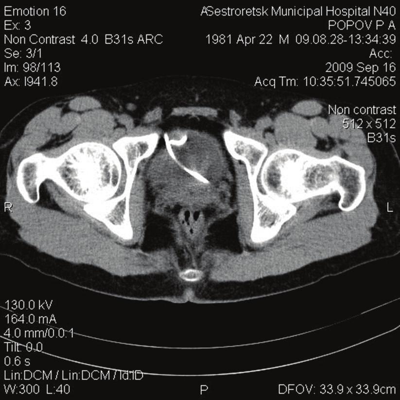 But almost immediately after admission to our hospital, spontaneous decrease of the pain was noted and thereafter a survey revealed a gap in the renal pelvis wall.