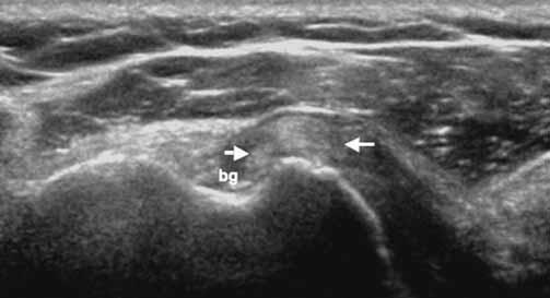 Biceps tendon instability Coracohumeral ligament tear