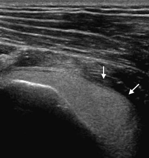 Glenohumeral joint