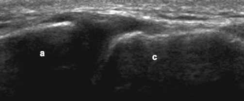 Acromioclavicular joint instability Hematoma in