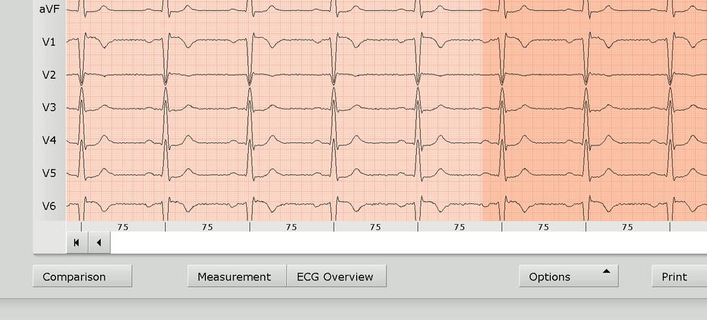 Navigation in the resting ECG evaluation The buttons for opening further evaluation screens are located at the bottom of the