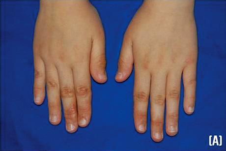 Dapsone Hypersensitivity Syndrome in Patients with Erythema Elevatum Diutinum Fig. 1.