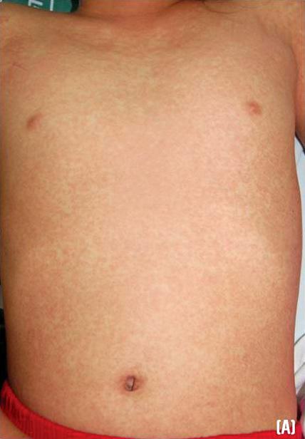 GW Kim, et al Fig. 3. Symmetrically arranged, brightly erythematous macules and papules on trunk (A), arms (B), legs (C) and face with edematous swelling (D). virus.