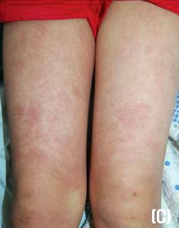 DISCUSSION EED is a chronic recurrent form of cutaneous leukocytoclastic vasculitis thought to be immune-complex mediated 4,5.