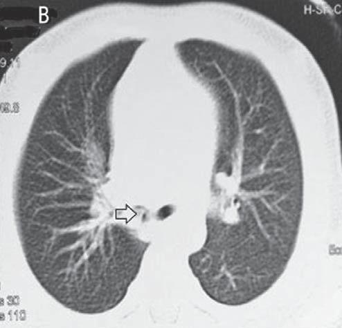 the right main ; CT coronal scan (A); CT axial scan (B). FIGURE 2.