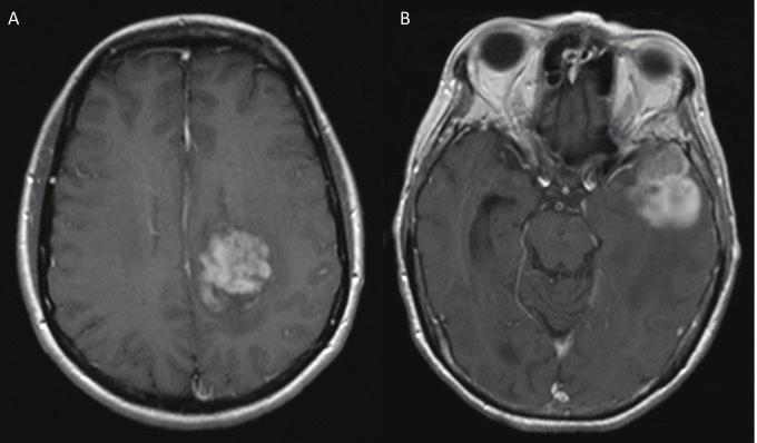 Current Management of Brain Metastases: Overview and Teaching Cases http://dx.doi.org/10.