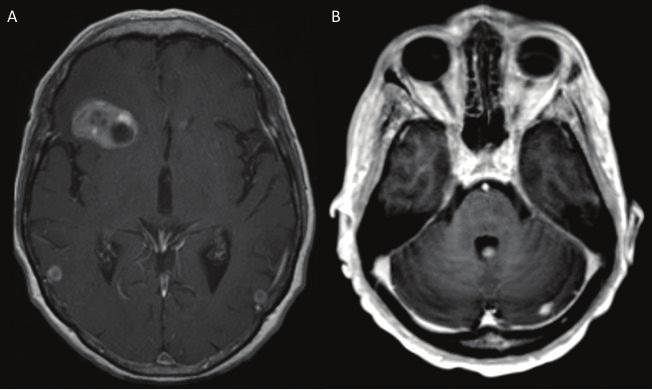 134 New Approaches to the Management of Primary and Secondary CNS Tumors for a large, symptomatic lesion among multiple, or for a lesion in a high-risk location for mass effect such as the cerebellum