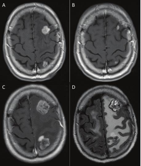 136 New Approaches to the Management of Primary and Secondary CNS Tumors Figure 4. (A) Pre-treatment gadolinium contrast-enhanced T1 MRI showing two left-sided metastases.